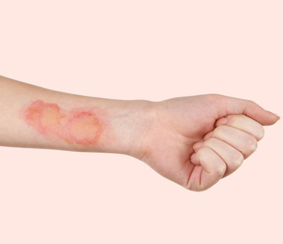minor burns minor burns
