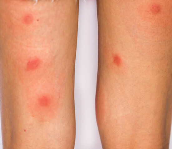 Identifying Common Insect Bites and Stings